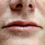 lip filler treatment- after
