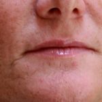 Lip filler treatment -before